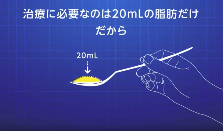 培養幹細胞治療に必要な脂肪量は20ml