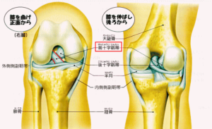 膝についてしりましょう(レントゲンとMRIの違い)